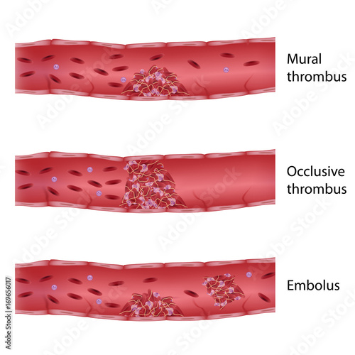 Types of thrombosis 