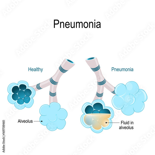 Pneumonia. Illustration shows normal and infected alveoli.