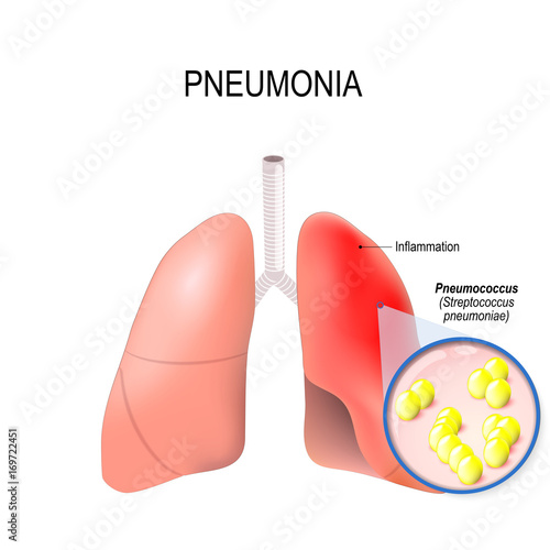 Pneumonia. Normal and inflammatory condition of the lung.