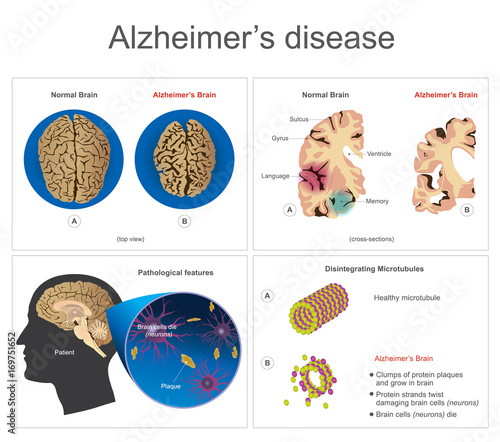 Alzheimer’s disease. Brain cells die, neuron diseased, certain areas of brain shrink memory loss or changes in memory for people age 65 and up at risk could affect younger people. Info graphic vector.