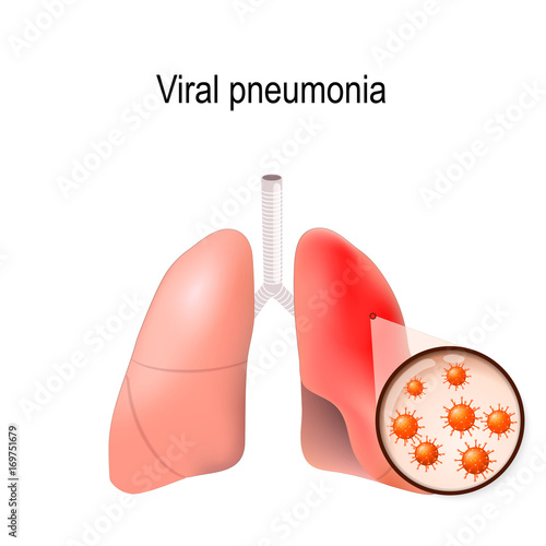 Viral pneumonia. Normal and inflammatory condition of  human lungs