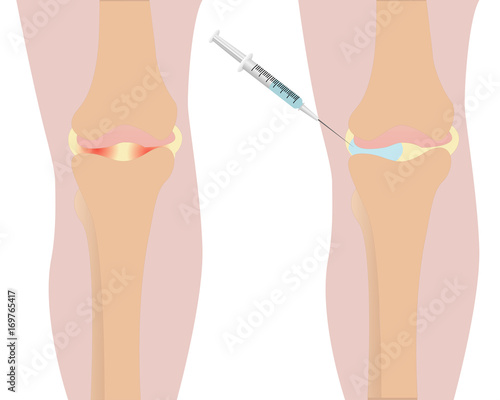 Knee injection inflamation redness vector illustration