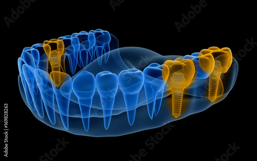 X-ray view of denture with implants . Xray view. Medically accurate 3D illustration