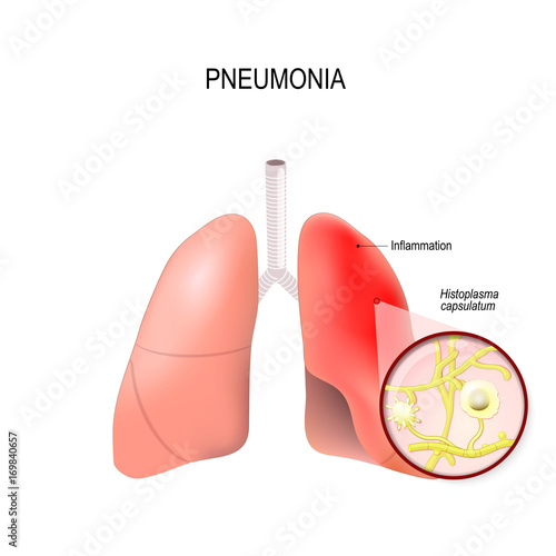 Pneumonia or Histoplasmosis. Normal and inflammatory condition of the lung