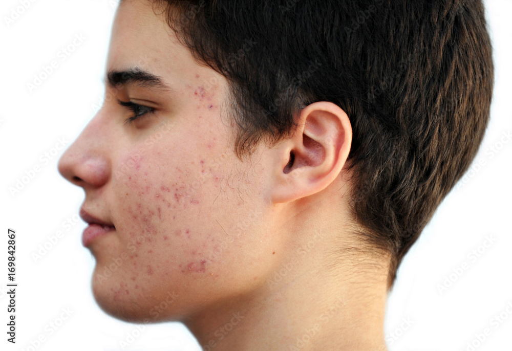 Teenager with Acne/ Adolescente con acné Stock Photo | Adobe Stock