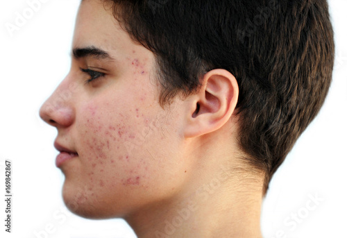 Teenager with Acne/ Adolescente con acné