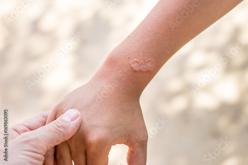 Dermatosis, skin diseases infectious. Allergy on the skin. photo