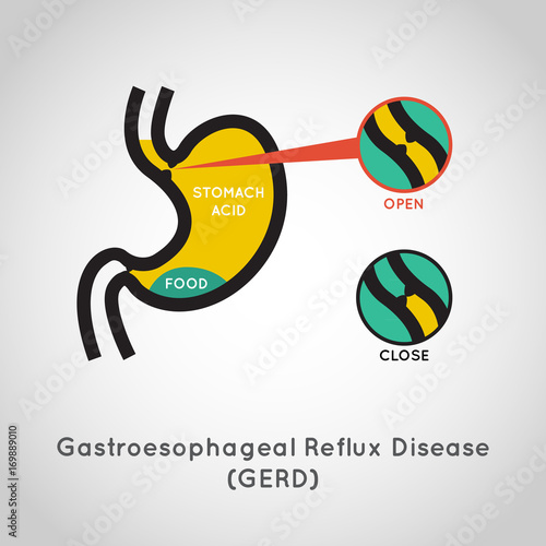 Gastroesophageal Reflux Disease (GERD) vector collection