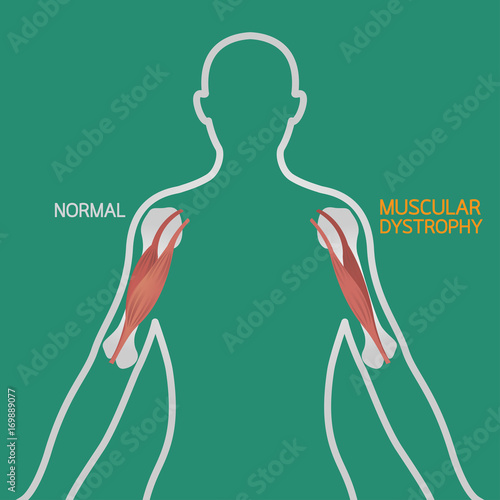 Muscular dystrophy vector illustration photo