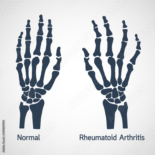 Rheumatoid Arthritis vector icon illustration