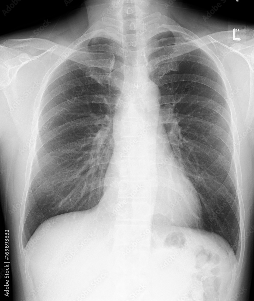 Film regular chest PA. Heart size, diaphragm and costophrenic sulci are