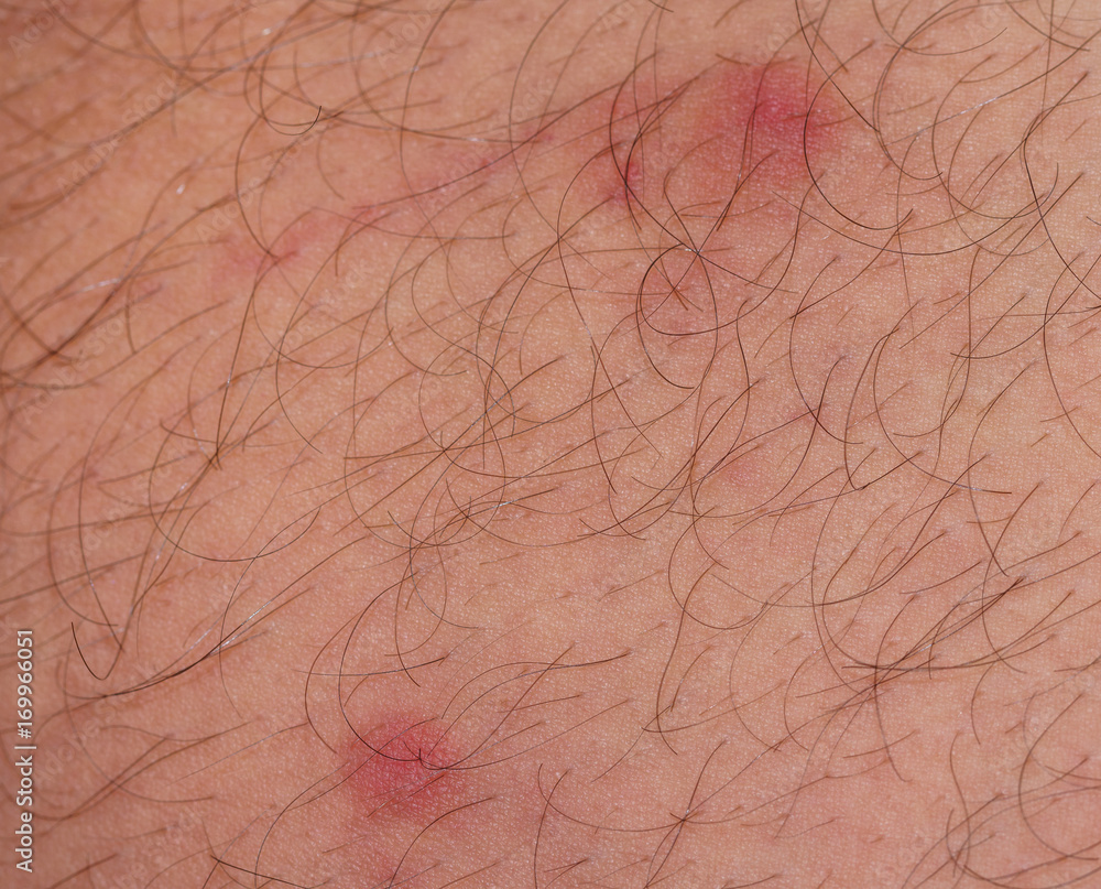 closeup of redness over caucasian skin closeup of redness over caucasian skin