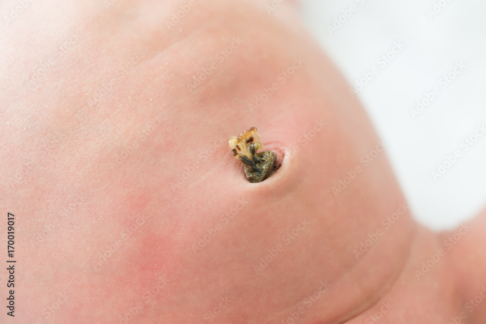 Close up of navel newborn baby boy Close up of navel newborn baby boy