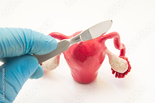 Fallopian tube surgery for treat infertility or ectopic pregnancy photo concept. Doctor's hand with a scalpel is above the anatomical model of the uterus with fallopian tubes and ovaries photo