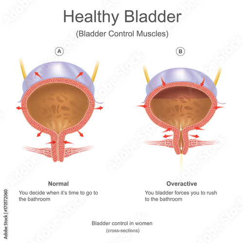 Healthy bladder in women. Infographic Vector. 