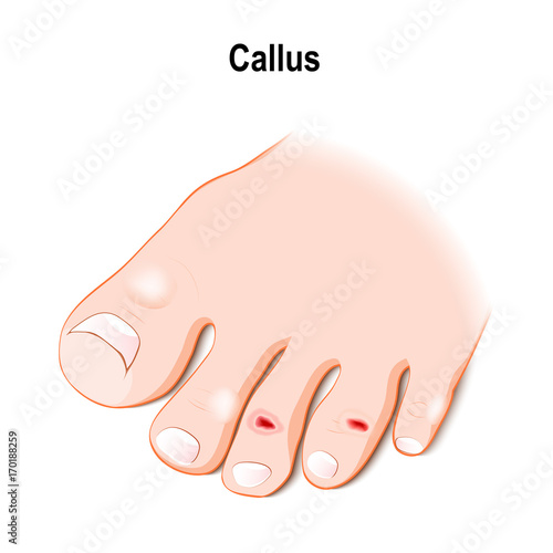 callus or callosity. human's foot with callus, wound, blisters and ulcer