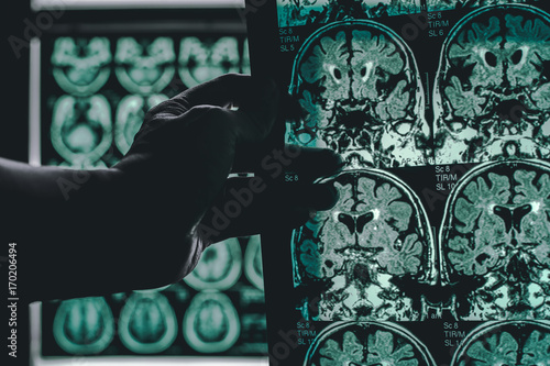 Canvastavla alzheimer's disease on MRI