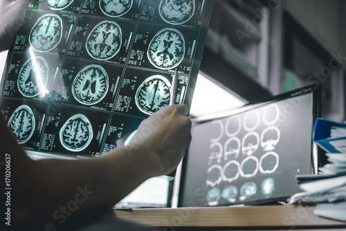 alzheimer's disease on MRI