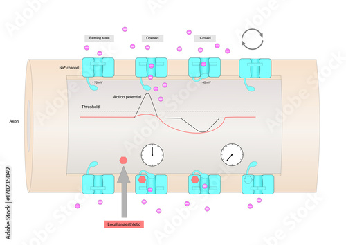 Mechanism of action of a local anesthetic (or anaesthetic), inhibiting voltage-gated sodium channels.