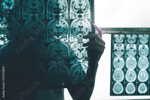 Obraz na plátně Alzheimer's disease on MRI film