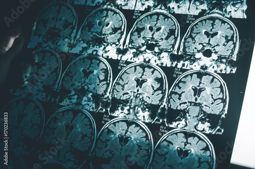 Alzheimer's disease on MRI film 