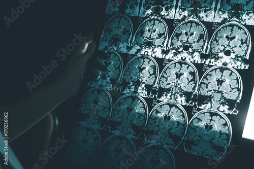 Alzheimer's disease on MRI film 
