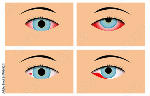 Conjunctivitis and Red Bloodshot Eyes, vector
