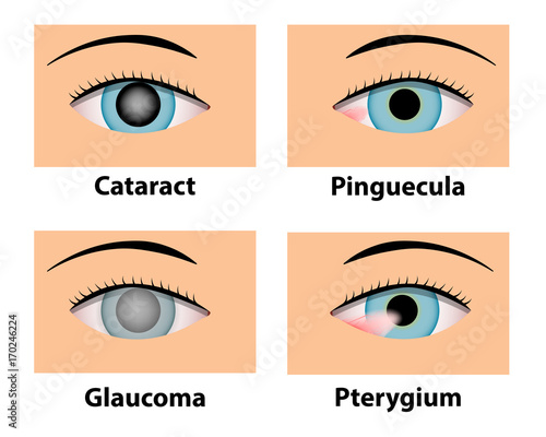 Cataract, Pinguecula, Glaucoma and Pterygium, eye care photo