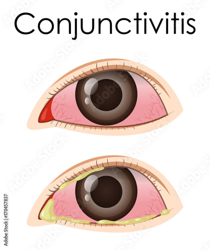 Diagram showing conjunctivitis in human