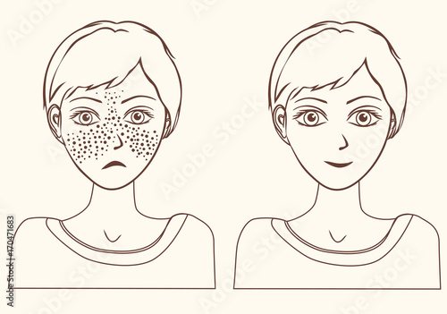 Concept for girl remove freckles outline.