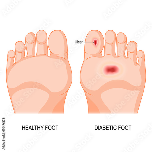 diabetic foot