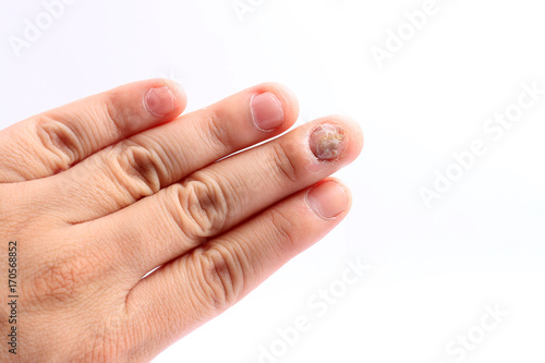 Fungus Infection on Nails Hand, Finger with onychomycosis, Fungal infection on nails handisolated on white background.