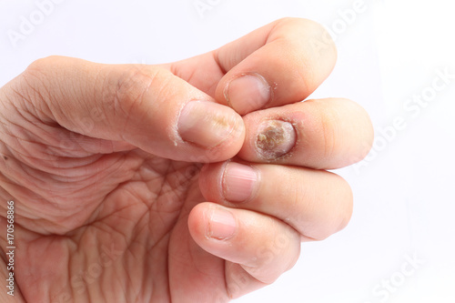 Wallpaper Mural Fungus Infection on Nails Hand, Finger with onychomycosis, Fungal infection on nails handisolated on white background. Torontodigital.ca