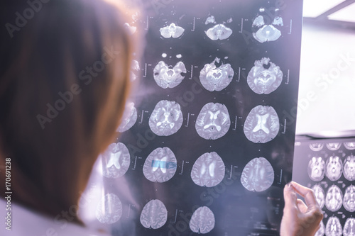 stroke on MRI file multiple small hemorrhagic