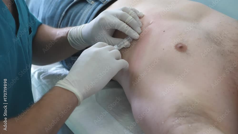 Hand of male doctor makes an injection to patient body before operation. Anesthesiologist gives anesthesia. Physician stabs with needle in the ribs, arm with protective surgical gloves. Close up Hand of male doctor makes an injection to patient body before operation. Anesthesiologist gives anesthesia. Physician stabs with needle in the ribs, arm with protective surgical gloves. Close up