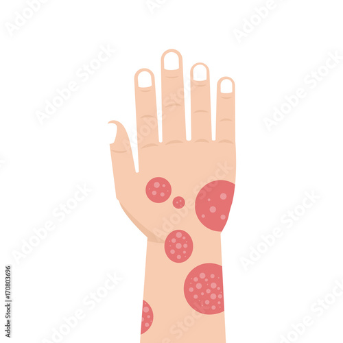 Hand with psoriasis or Eczema. Vector illustration.