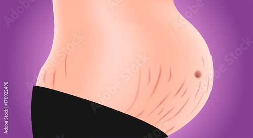 stretch marks on body . Skin care concept vector
