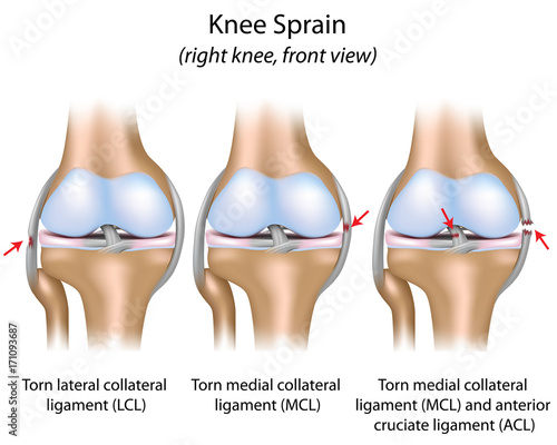Photography Knee sprain