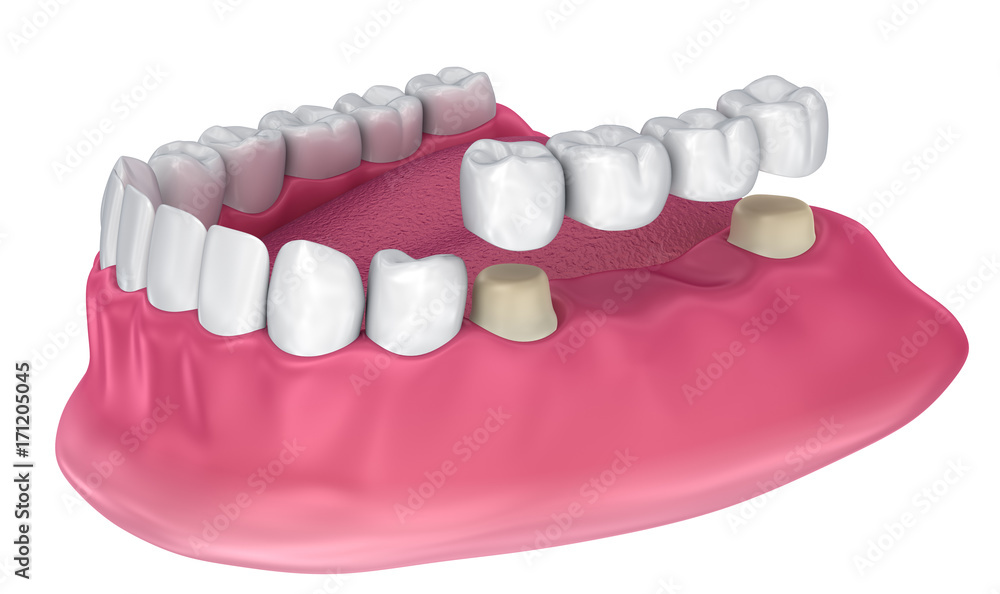 Fototapeta premium Tooth supported fixed bridge. Medically accurate 3D illustration