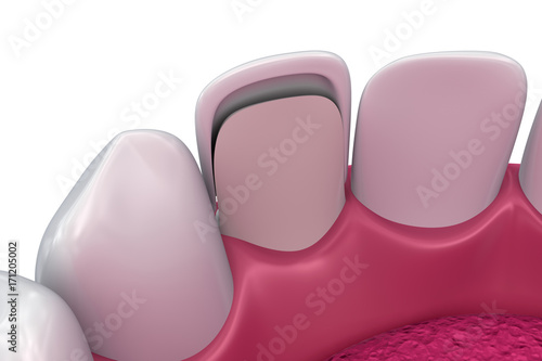 Dental Veneers: Porcelain Veneer installation Procedure. 3D illustration