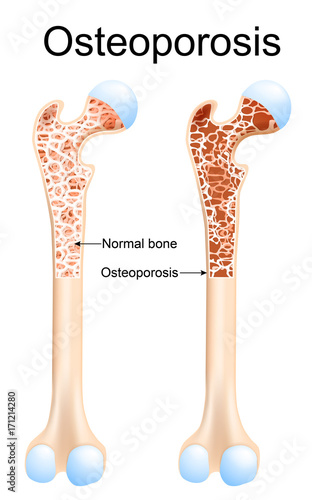 Osteoporosis