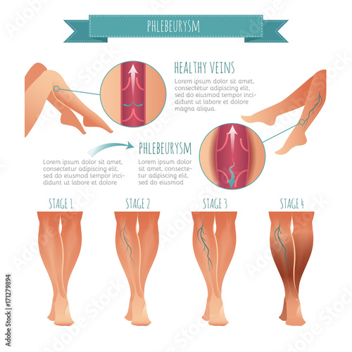 Vector Phlebology infographic. Stage of vein diseases