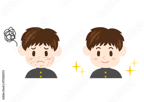 男性 悩み 学生 ニキビ 吹き出物 イラスト Stock Vector Adobe Stock