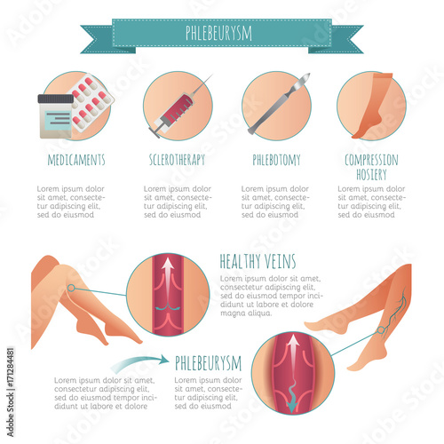 Vector Phlebology infographic, treating varicose veins. Female legs. Medical compression hosiery