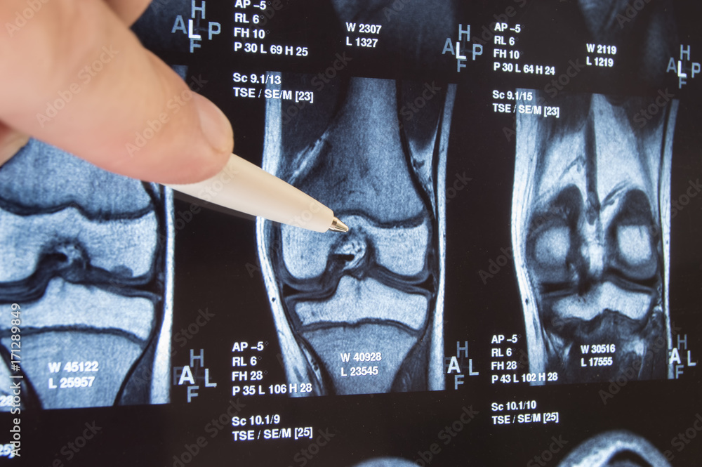 Naklejka Knee joint x-ray or MRI. Doctor pointed on area of knee joint,  where pathology or problem is detected, such fracture, destruction of  joint, osteoarthritis. Diagnosis of knee diseases by radiology -