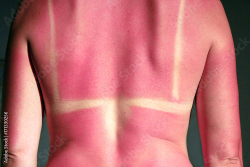 Back burnt after sunburn