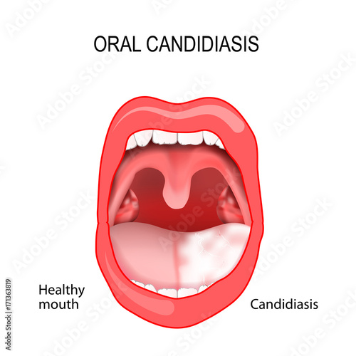 Oral candidiasis
