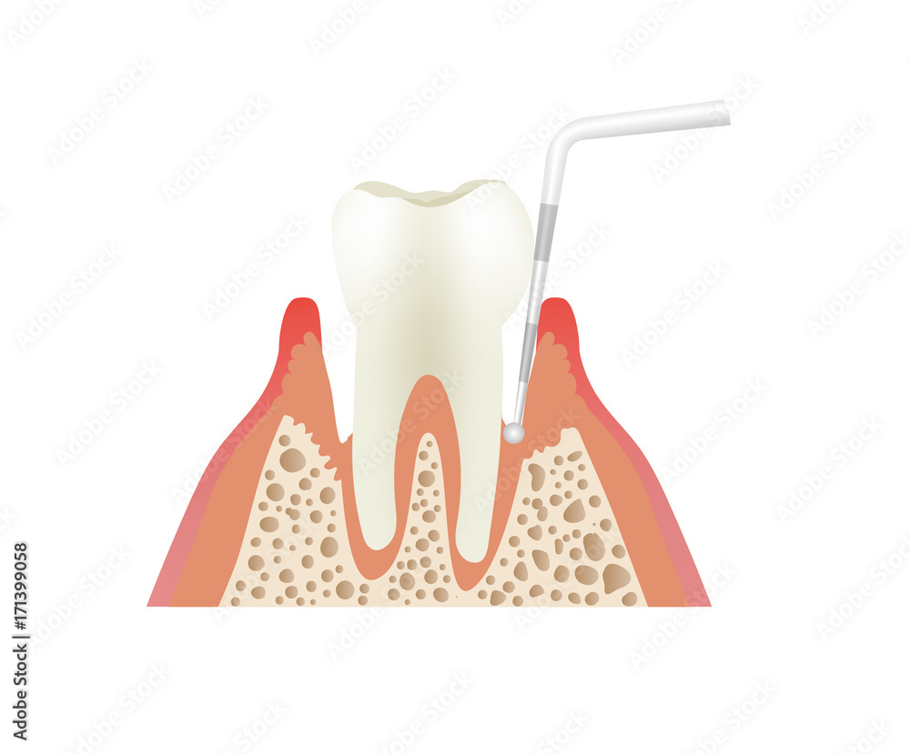 歯周ポケットのプローブ検査 Stock イラスト Adobe Stock