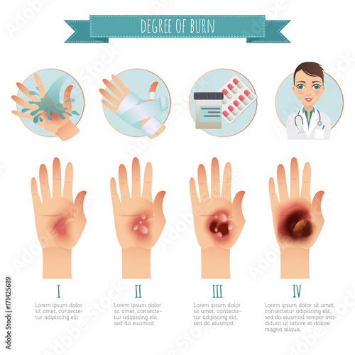 Burns Treatment. Degree of skin burns. Vector infographic. Flat Illustration for websites, brochures, magazines etc