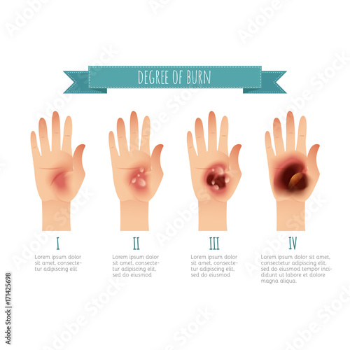 Degree of skin burns. Flat vector illustration for websites, brochures, magazines etc